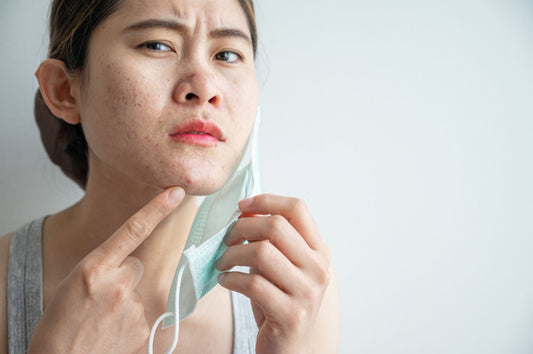 Everything You Need To Know About Acne